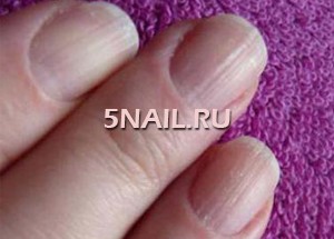 Неровная ногтевая пластина на большом пальце 35